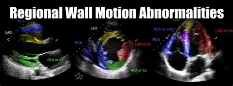 what is rwma in cardiology.